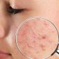 6 Rekomendasi Skincare untuk Kulit Berjerawat Buat Jerawat Bandel Hilang